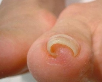 フットケア先進国ドイツで人気の巻き巻き爪矯正「B/Sスパンゲ」