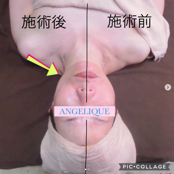 たるみ、ほうれい線が気になる方にサムネイル