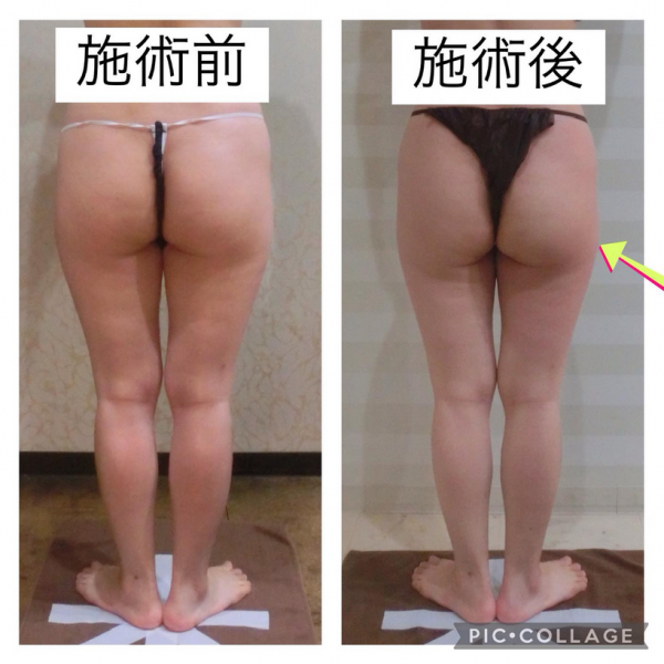 気持ちいい高周波痩身セルゼロ2サムネイル