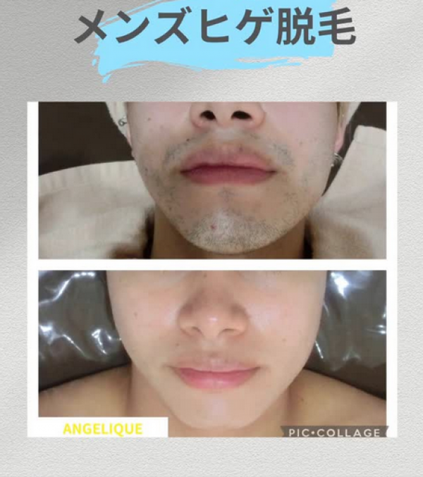 メンズひげ脱毛のお客様ビフォーアフターサムネイル