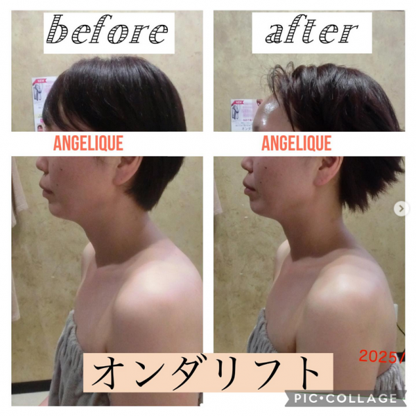 大人気のオンダリフトでフェイスラインスッキリ！！サムネイル